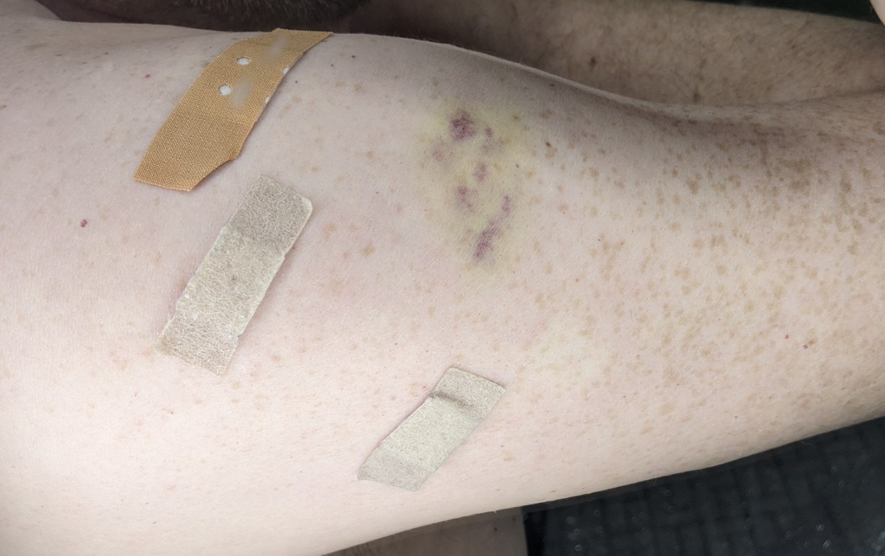 rechter menschlicher Arm mit drei Pflastern und einem Bluterguss als Nebenwirkung von vier Impfungen 