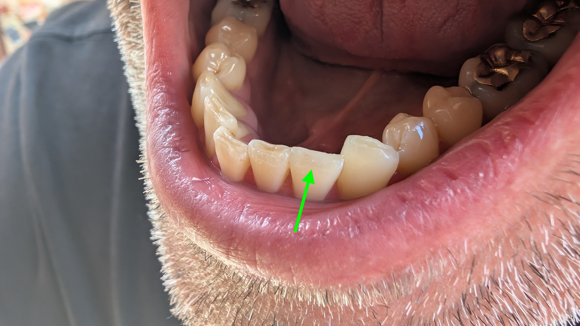 Abbildung von einem menschlichen Gebiss mit markierten Zahn der repariert wurde 